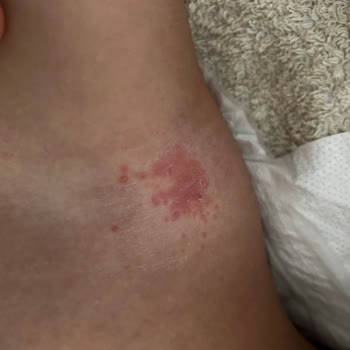 Molfix Bebek Bezi Cilt Sorununa Yol Açtı, Ücret İadesi Talep Ediyorum