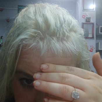 Kuaförde Saç Boyama Sonrası Ciddi Yanık Ve Mağduriyet Yaşadım