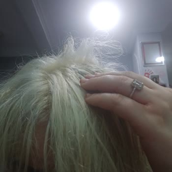 Kuaförde Saç Boyama Sonrası Ciddi Yanık Ve Mağduriyet Yaşadım