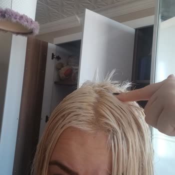 Kuaförde Saç Boyama Sonrası Ciddi Yanık Ve Mağduriyet Yaşadım