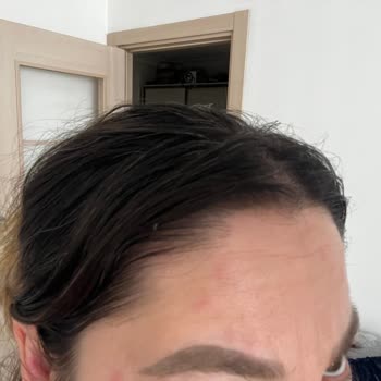 The Ordinary Ürünleri Yüzümde Alerji Ve Tahrişe Yol Açtı