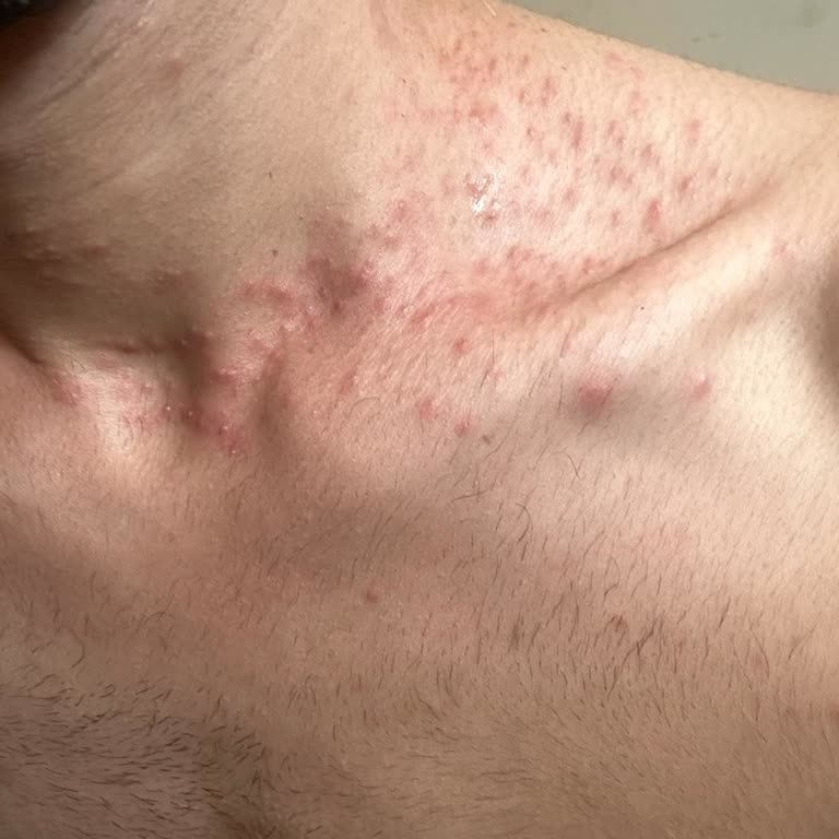 Hautausschlag nach Einnahme von Solgar Vitamin B12