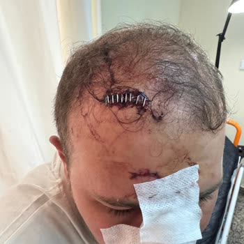 I Face Severe Head Injury and Refund Refusal at Airbnb Villa with Private Pool