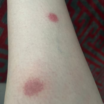 Farmasec Ürünü Kullandıktan Sonra Vücudumun Farklı Yerlerinde Şiddetli Alerji Ve Yaralar Oluştu