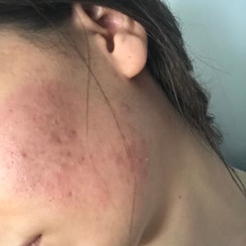 Abdi İbrahim Hametan Krem Cildimde Kızarıklık Yaptı!