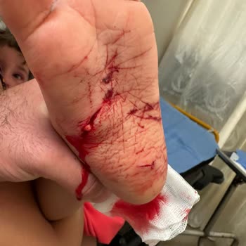 Oğlum Havuzda Yaralandı Otelden İlgi Ve İade Alamadık