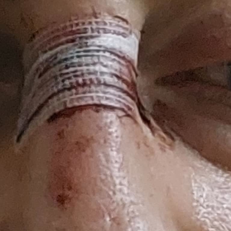 Gözlük Çerçevesi Kazası Sonucu Fiziksel Ve Psikolojik Mağduriyet