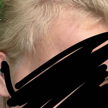 Saç Boyası Sonrası Ciddi Saç Ve Deri Hasarı