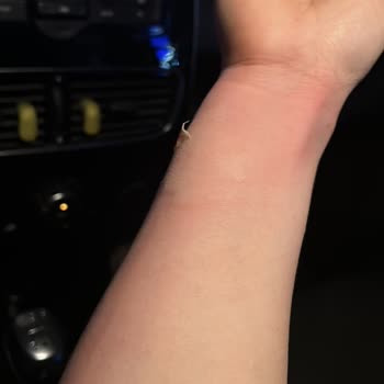 Stanley Termos Kullanımında Ciddi Yanık Ve Mağduriyet Yaşadım!