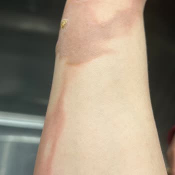 Stanley Termos Kullanımında Ciddi Yanık Ve Mağduriyet Yaşadım!