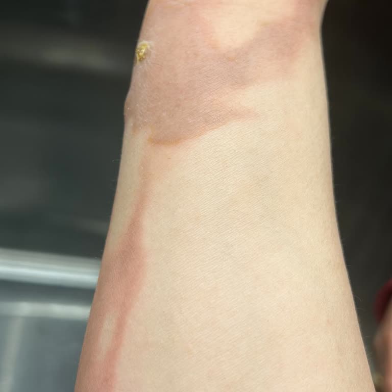 Stanley Termos Kullanımında Ciddi Yanık Ve Mağduriyet Yaşadım!