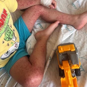 Crystal Sunset Otel’de Hijyen Eksikliği Nedeniyle Hastalık Ve İlgisiz Yönetim Mağduriyeti