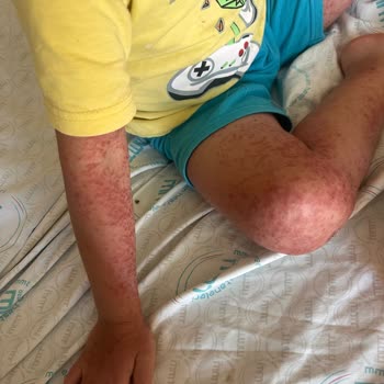 Crystal Sunset Otel’de Hijyen Eksikliği Nedeniyle Hastalık Ve İlgisiz Yönetim Mağduriyeti