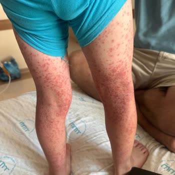 Crystal Sunset Otel’de Hijyen Eksikliği Nedeniyle Hastalık Ve İlgisiz Yönetim Mağduriyeti