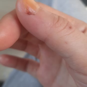 Eğitimsiz Ve Ekipmansız Cila İşi Sonucu Ağır İş Kazası Mağduriyeti