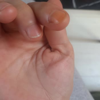 Eğitimsiz Ve Ekipmansız Cila İşi Sonucu Ağır İş Kazası Mağduriyeti