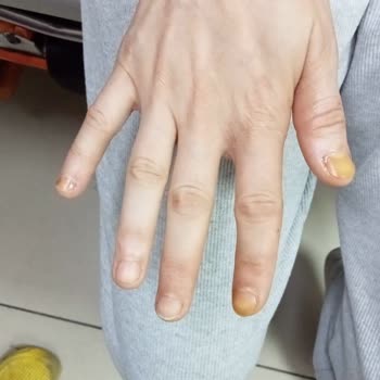 Eğitimsiz Ve Ekipmansız Cila İşi Sonucu Ağır İş Kazası Mağduriyeti