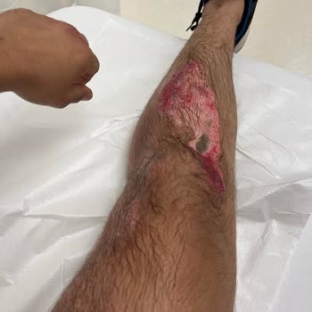 Yetkili Servis İhmalinden Ölümden Döndüm: Can Güvenliğim Tehlikeye Atıldı