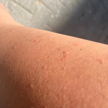 Güneş Sonrası Losyon Ciddi Alerjik Reaksiyon Ve İzler Bıraktı Acil Çözüm Bekliyorum