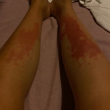 Güneş Sonrası Losyon Ciddi Alerjik Reaksiyon Ve İzler Bıraktı Acil Çözüm Bekliyorum