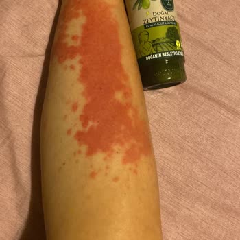 Güneş Sonrası Losyon Ciddi Alerjik Reaksiyon Ve İzler Bıraktı Acil Çözüm Bekliyorum