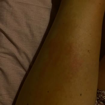 Güneş Sonrası Losyon Ciddi Alerjik Reaksiyon Ve İzler Bıraktı Acil Çözüm Bekliyorum