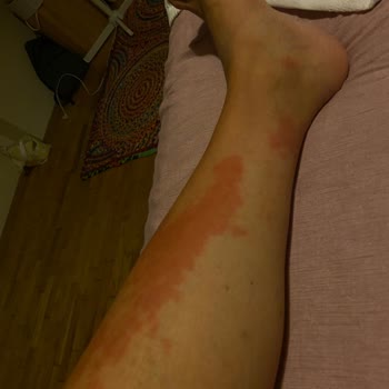 Güneş Sonrası Losyon Ciddi Alerjik Reaksiyon Ve İzler Bıraktı Acil Çözüm Bekliyorum