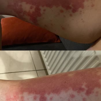 Güneş Sonrası Losyon Ciddi Alerjik Reaksiyon Ve İzler Bıraktı Acil Çözüm Bekliyorum