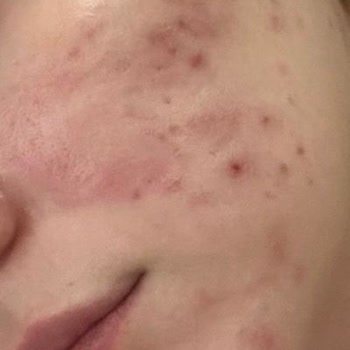 Düğün Öncesi Yapılan Agresif Cilt Bakımı Sonucu Yüzümde Yaralar Ve Psikolojik Mağduriyet