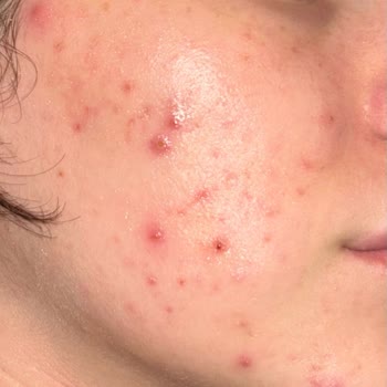 Düğün Öncesi Yapılan Agresif Cilt Bakımı Sonucu Yüzümde Yaralar Ve Psikolojik Mağduriyet