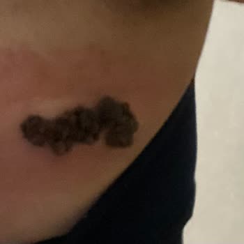 Şişli Etfal Araştırma Hastanesi Yanlış Tedavi Sonrası Enfeksiyon, İlgisizlik Nedeniyle Mağdur Oldum