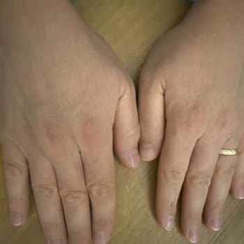 Activex Antibakteriyel Hassas Sıvı Sabun Ciltte Ciddi Sorunlara Yol Açtı