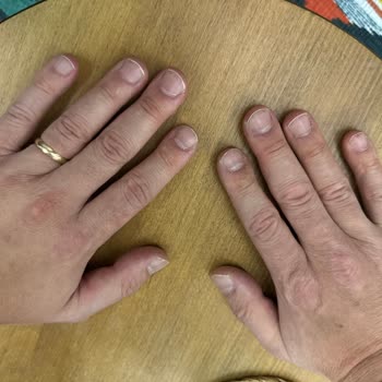 Activex Antibakteriyel Hassas Sıvı Sabun Ciltte Ciddi Sorunlara Yol Açtı