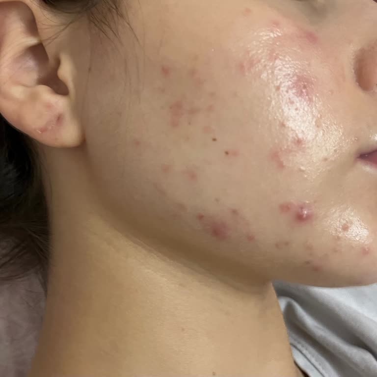 Garnier C Vitamini Güneş Kremi Cildimde Şiddetli Reaksiyona Sebep Oldu