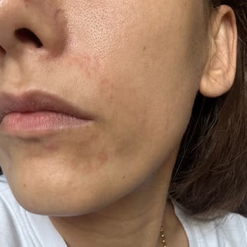 Skin Sensual Ürünleri Yüzümde Yayılan Bir Reaksiyon Oluşturdu