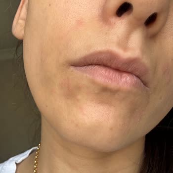 Skin Sensual Ürünleri Yüzümde Yayılan Bir Reaksiyon Oluşturdu