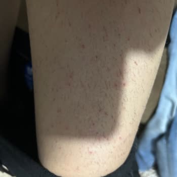 Tüy Dökücü Krem Cildimde Kaşıntı Ve Kızarıklığa Yol Açtı, İade Talep Ediyorum