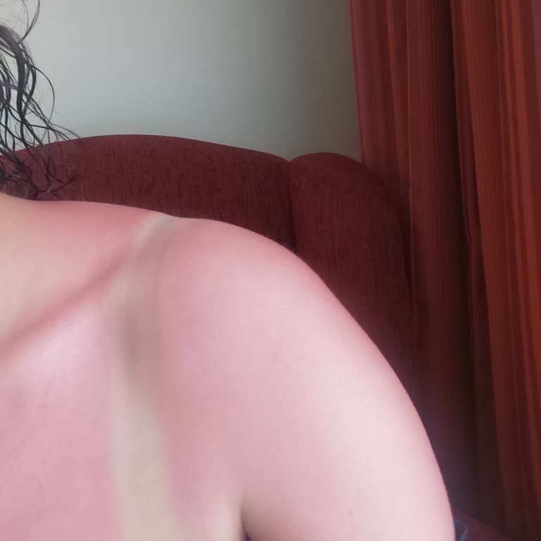 Çocuklar İçin Alınan Güneş Spreyi Cildi Korumadı, Ciddi Kızarıklık Oluştu