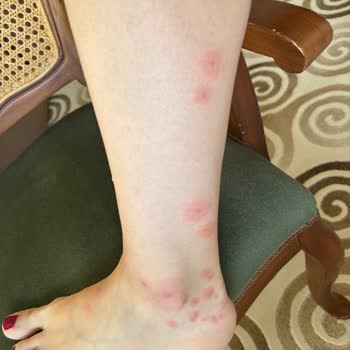 Oteldeki Yatak Böcekleri Nedeniyle Sağlık Sorunu Yaşadım, Jolly Tur'dan İade Talep Ediyorum