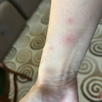 Oteldeki Yatak Böcekleri Nedeniyle Sağlık Sorunu Yaşadım, Jolly Tur'dan İade Talep Ediyorum