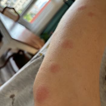 Oteldeki Yatak Böcekleri Nedeniyle Sağlık Sorunu Yaşadım, Jolly Tur'dan İade Talep Ediyorum