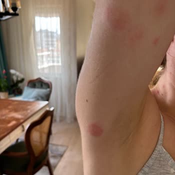 Oteldeki Yatak Böcekleri Nedeniyle Sağlık Sorunu Yaşadım, Jolly Tur'dan İade Talep Ediyorum