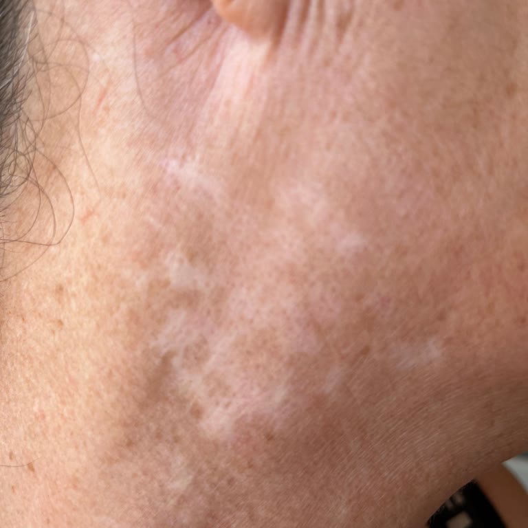 Lazer İşlemi Sonrası Kalıcı Hasar Ve İlgisiz Yaklaşım