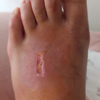 Aldığımız Ayakkabı Eşimin Ayağında Ciddi Yaraya Ve Enfeksiyona Sebep Oldu