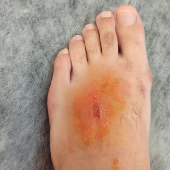 Aldığımız Ayakkabı Eşimin Ayağında Ciddi Yaraya Ve Enfeksiyona Sebep Oldu