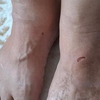 İlk Kullanımda Sorunlu Terlik Ve Yetersiz Bilgilendirme Sonucu Mağduriyet