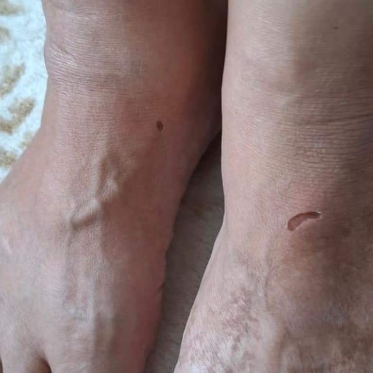 İlk Kullanımda Sorunlu Terlik Ve Yetersiz Bilgilendirme Sonucu Mağduriyet