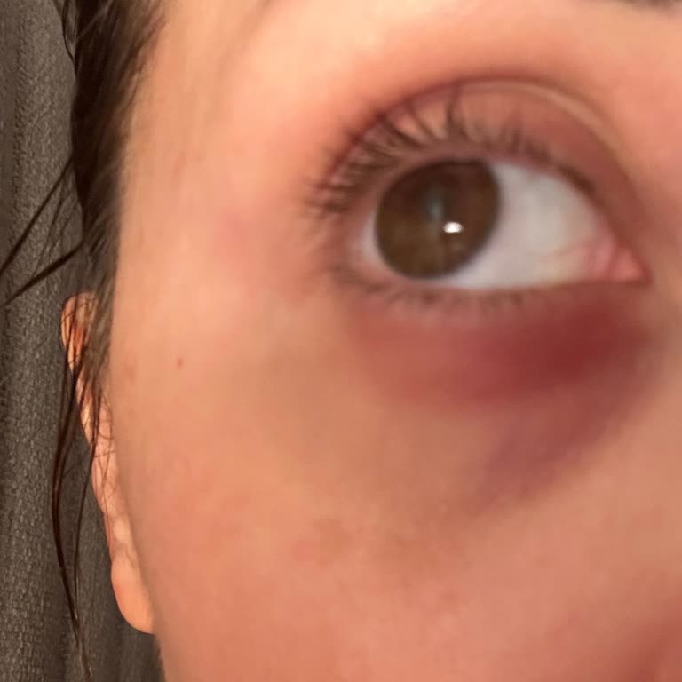 Alerjiye Sebep Olan Maskara Ve Yetersiz Müşteri Hizmeti