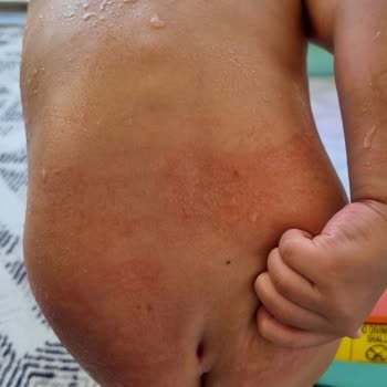 Molfix Külot Bez Bebeğimde Alerjiye Sebep Oldu