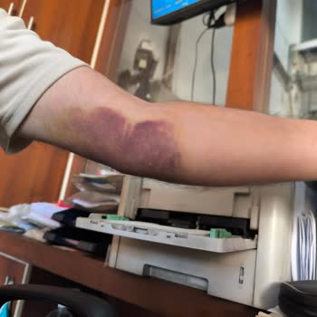 Türk Kızılay Kan Bağışı Sonrası Kolumda Ağrı Ve Morarma Yaşadım!